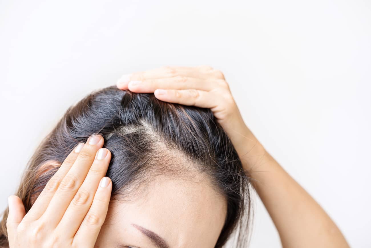 Alopecia areata: qué es, por qué se produce y cómo tratarla